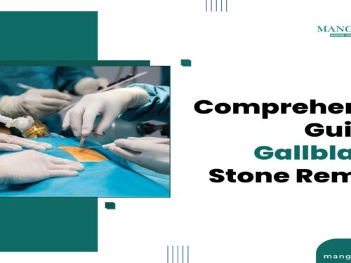 A Comprehensive Guide to Gallbladder Stone Removal