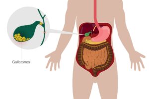 Gallbladder Stone Removal