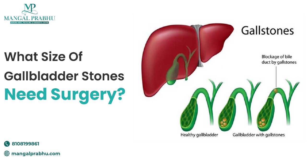 Gallbladder Stones: What Size Requires Surgery?