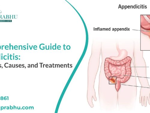 A Comprehensive Guide to Appendicitis: Symptoms, Causes, and Treatments