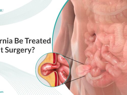 Can Hernia Be Treated Without Surgery?