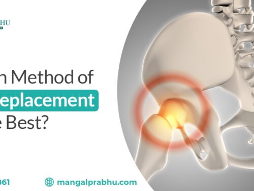 Which Method Of Hip Replacement Is The Best?