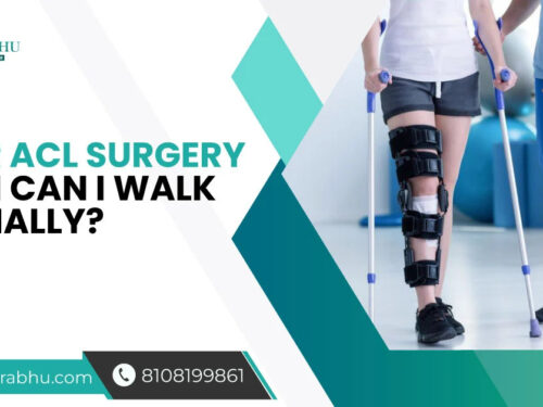 After ACL Surgery When Can I Walk Normally?