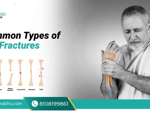 8 Types of Bone Fractures