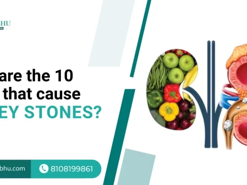 What are the 10 Foods that Cause Kidney Stones?