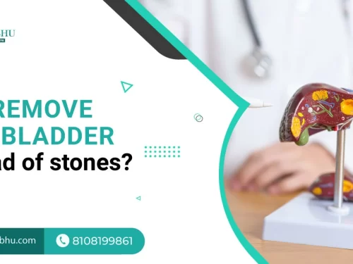 Why Remove Gallbladder Instead of Stones?